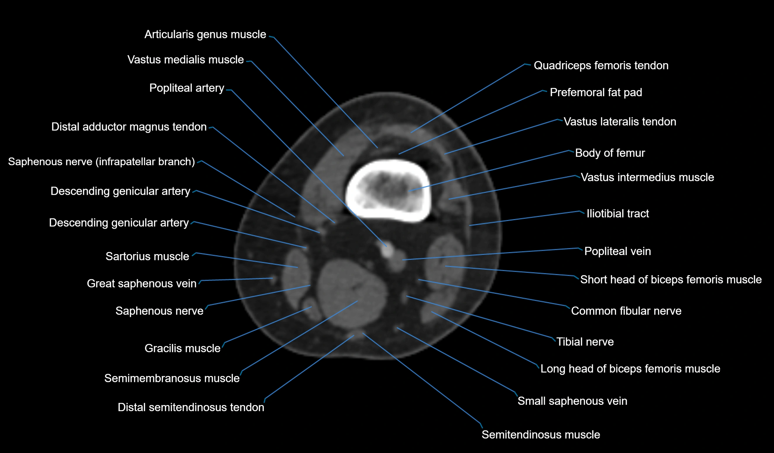 CT knee axial cross sectional anatomy labelled image-00014.webp